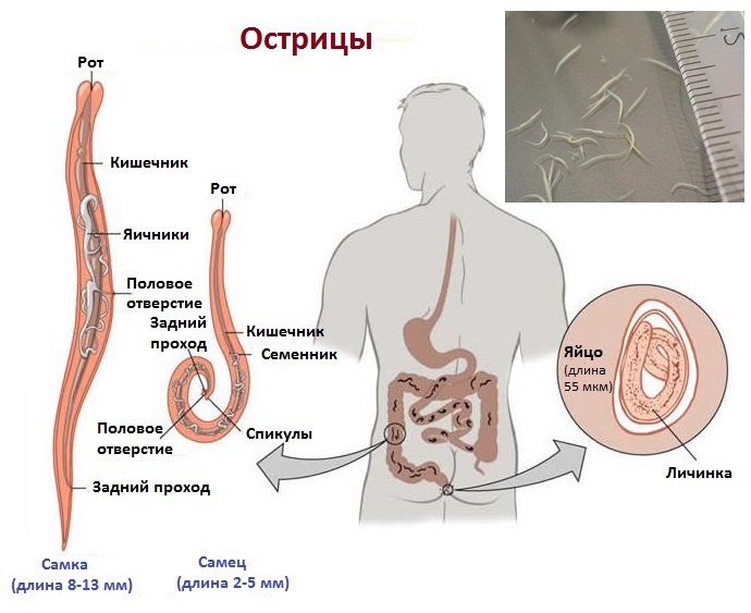Острицы - один из наиболее широко известных видов паразитов человека.