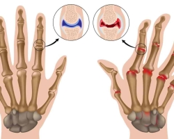 Les méthodes les plus efficaces pour traiter l'arthrite des doigts: injections, comprimés, procédures physiothérapeutiques, massage, thérapie d'exercice, folk, traitement à domicile, selon Sinelnikov