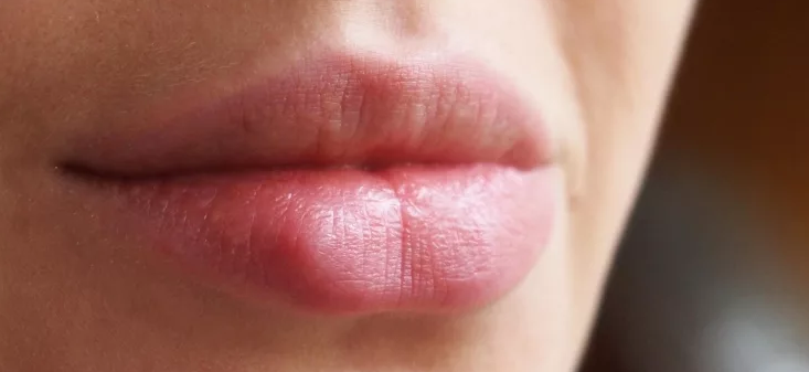 Herpes - swollen lip