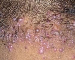 Acne on the head, nape, in the hair of men and women: causes, treatment, prevention. Treatment of acne on the head with folk methods, drugs and shampoos