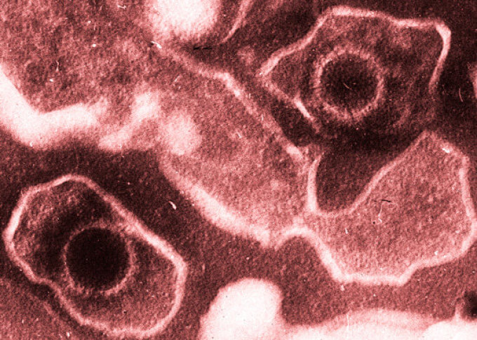 Вирус эпштейна-барр, опасный не только тем, что вызывает мононуклеоз, но и возможными онкологическими последствиями