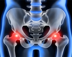 Synovite de l'articulation de la hanche: causes, symptômes, espèces. Traitement de la synovite de l'articulation de la hanche avec des méthodes folkloriques et des médicaments pharmacieux
