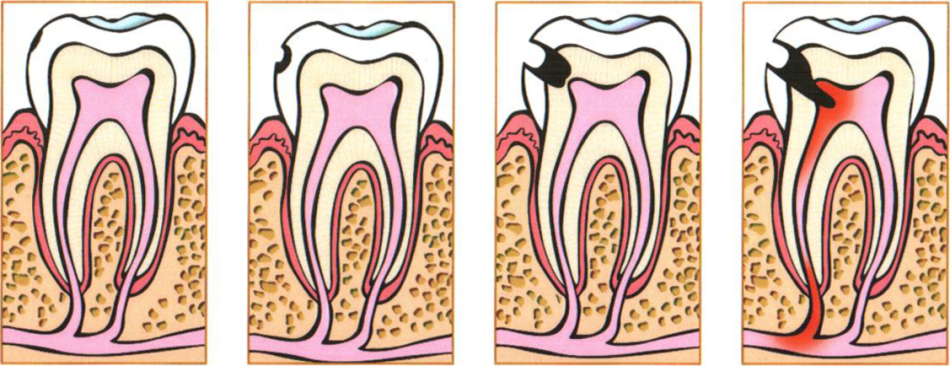 Penetration of infection into soft tissue