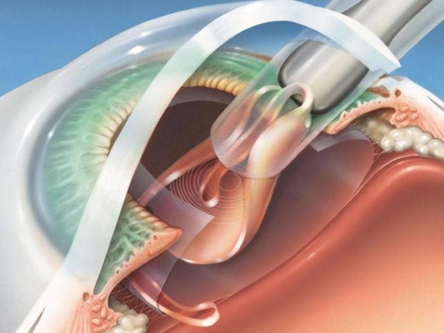 Cataracte de l'œil - opération laser, phacoémulsification des cataractes avec implantation de la LIO: comment se passe-t-il, ce qui se fait avec une lentille, les critiques
