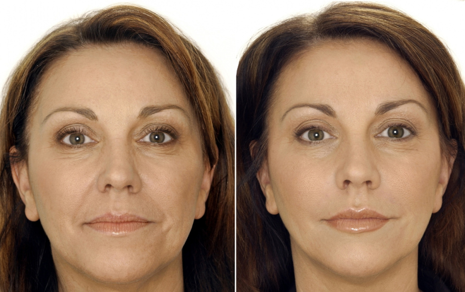 Mesotherapy - before and after