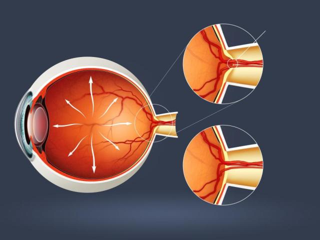 Glaukom očesa: Kaj je, vzroki, simptomi, posledice, preprečevanje