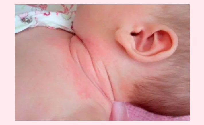 Draževanje kože pri dojenčkih