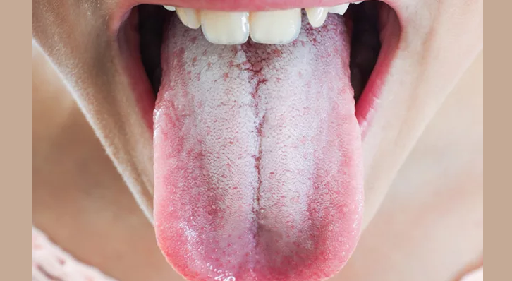 The tongue is covered, scheduled with a strong white cottage cheese raid in an adult