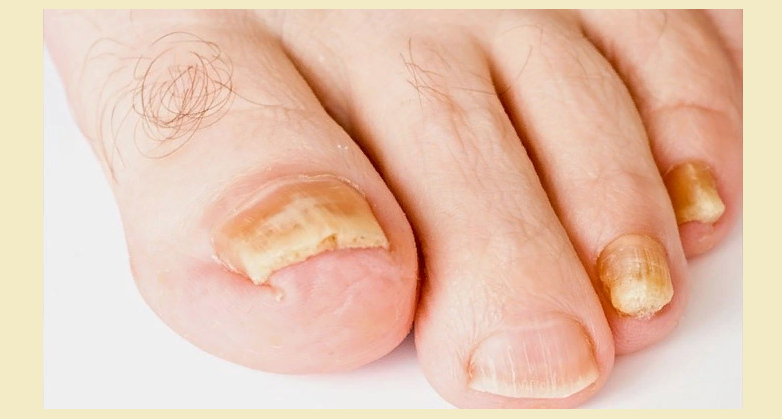 Онихомикоз: грибок ногтей на пальцах ног