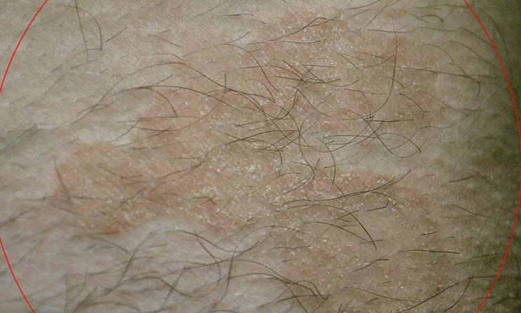 Miose - acne no púbis