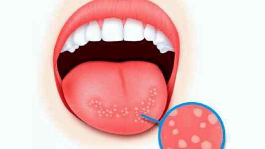 The child bit his lip, tongue or cheek very much to blood: what to do, how to help?