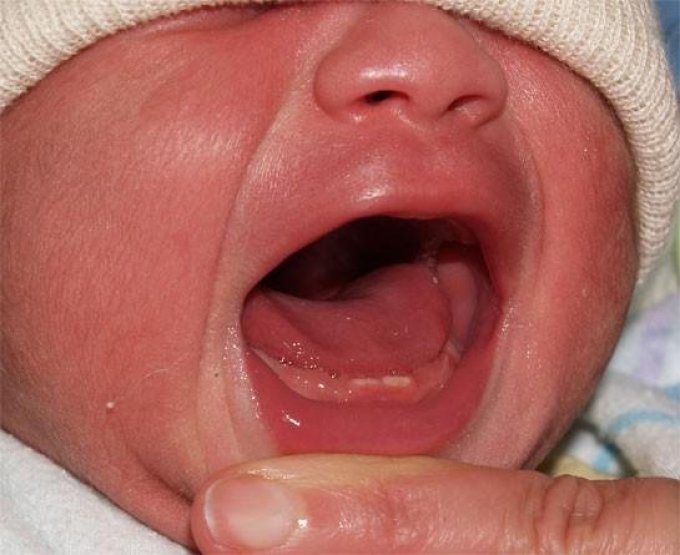 Otrok v 2, 3, 4 mesecih ima lahko prvi zob.