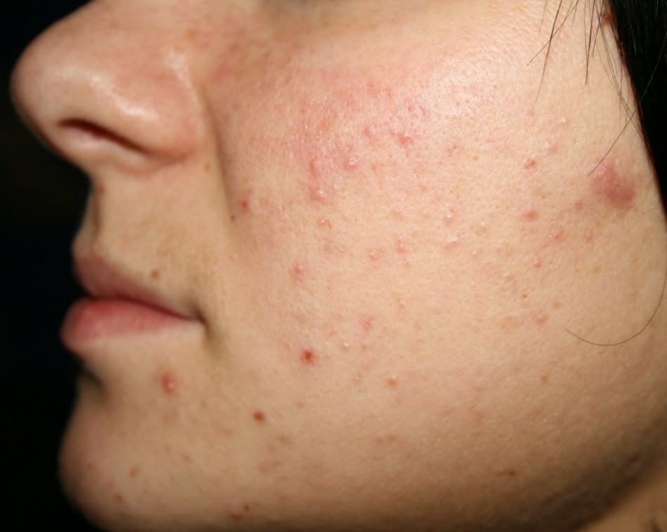 The causes of acne on the cheeks of women