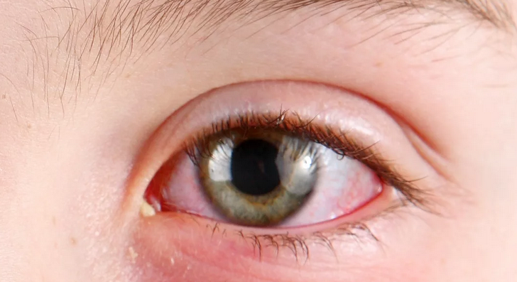 Fehér habos, filamentaris kisülés a szemből és a vörösség