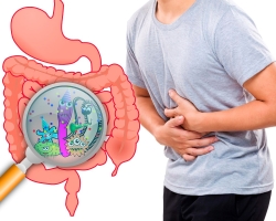 Intestinal microflora dysbiosis: symptoms, causes, diagnosis, treatment in adults and children