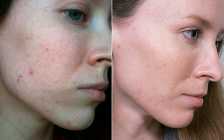 Traitement de l'acné métronidazole: photo avant et après