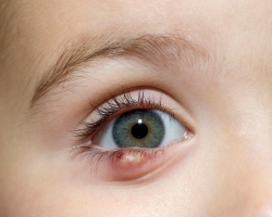 Πώς να αφαιρέσετε γρήγορα το κριθάρι από το μάτι, σε μια μέρα με ιατρικές και λαϊκές θεραπείες: συστάσεις, κατάλογος φαρμάκων, λαϊκές συνταγές