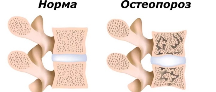 The spine hurts with osteoporosis after sleep