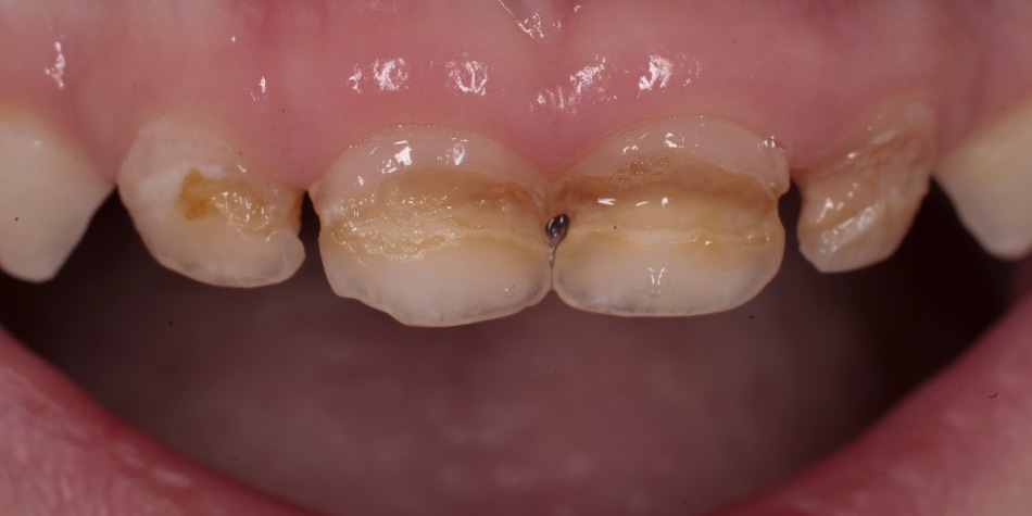 Caries distrugge i denti del bambino