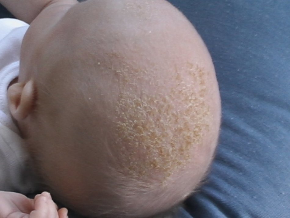 Des croûtes jaunes sur la tête d'un bébé