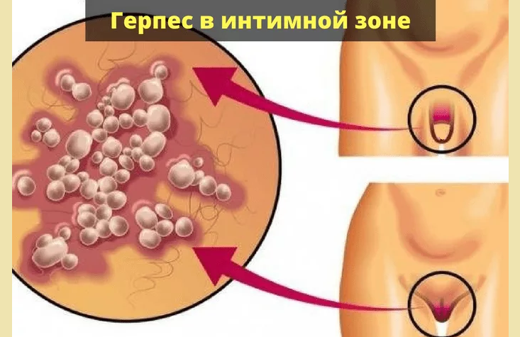 Genitalherpes - die Ursache von Akne auf der Pubis