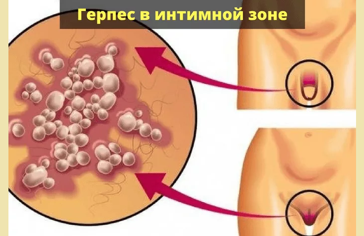 Генитальный герпес — причина прыщей на лобке