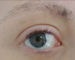 คิ้วและขนตาหลุดออกมาและผอม - นี่เป็นสัญญาณของโรคอะไร: เหตุผลที่ต้องทำวิธีการรักษาวิธีกำจัดยาอะไรที่ต่อต้านการสูญเสียยา?