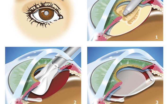 Katarakta očesa - operacija