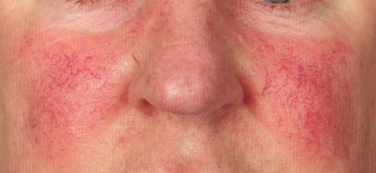 Rote Flecken im Gesicht