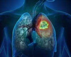 Lung fibrosis: treatment and average life expectancy after diagnosis
