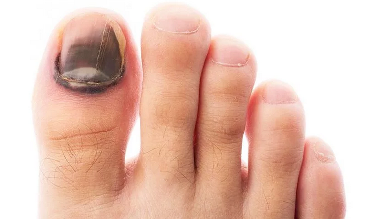 Изменение цвета ногтя нга пальце ноги говорит о болезни