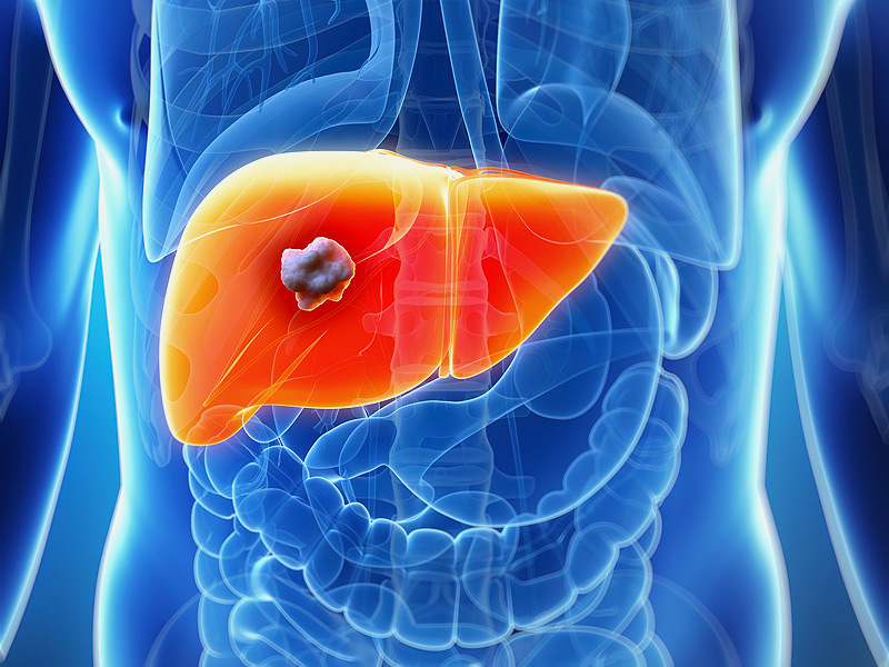 Liver cancer