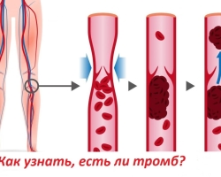 Comment savoir si une personne a un caillot de sang dans le corps dans les vaisseaux, dans les jambes, dans le cœur? Un thrombus s'est détaché - comment découvrir: pouvez-vous ressentir, voir un caillot de sang, pouvez-vous sauver une personne? Un caillot de sang peut-il aspirer les veines par vous-même?