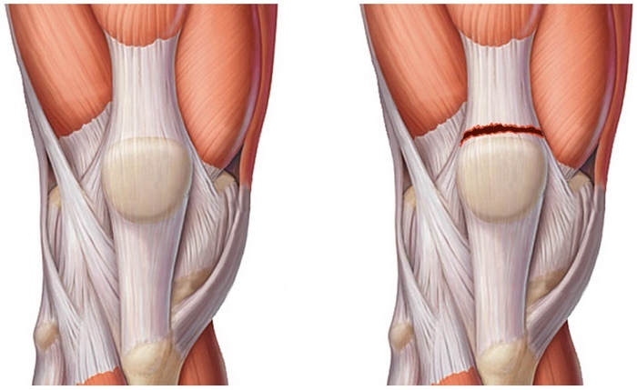 Stretching of ligaments of the knee joint