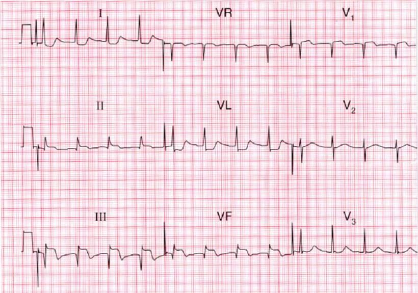 Bagaimana infark miokard didiagnosis dengan EKG?