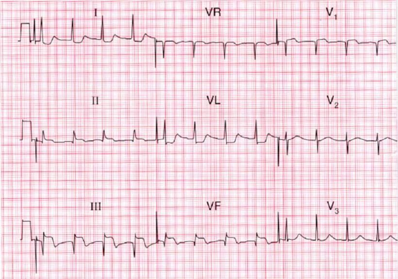 Come viene diagnosticato l'infarto del miocardio con ECG?