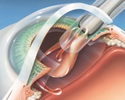 Katarak Operasi Laser Mata, Facoemulsifikasi Katarak dengan Implantasi IOL: Bagaimana Terjadi, Apa yang Dilakukan Dengan Lensa, Ulasan