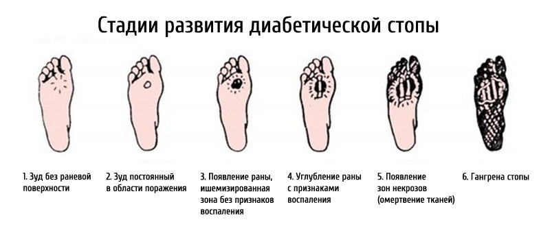 Stages of development of diabetic foot