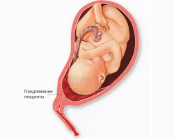 Petologies of the placenta during pregnancy: pathogenesis, types, diagnosis, complications