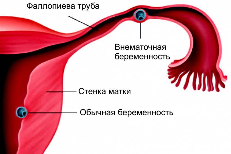 Схематическое изображение маточной полости