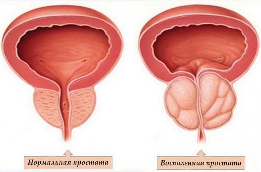 Inflammation of the prostate often has a bacterial nature.