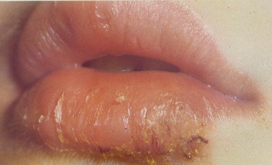 Le signe principal de l'héilite est l'apparition sur les lèvres des écailles grisâtres-jaune