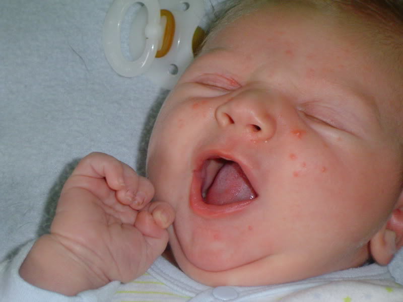 Vzroki za akne pri dojenčkih