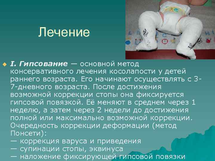 Clubfoot için alçı