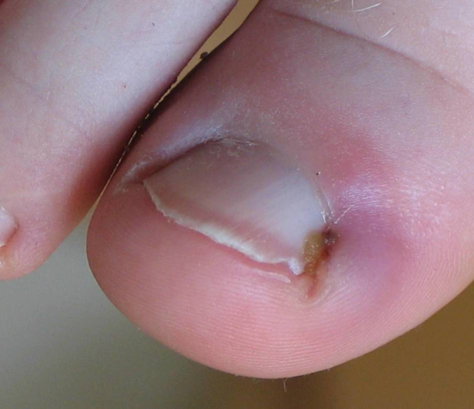 Деформация ногтя на ноге после обуви