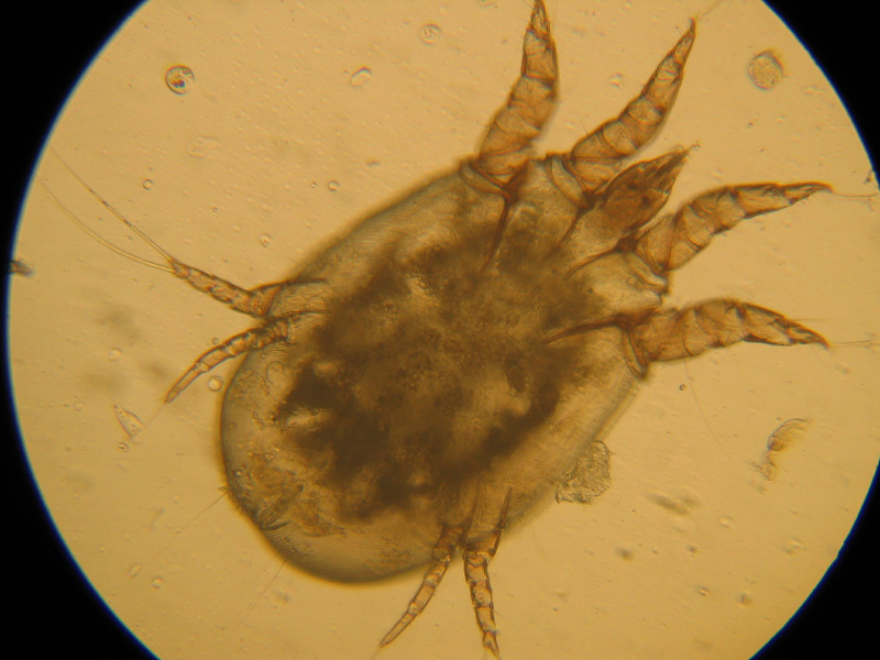 Scabies under a microscope
