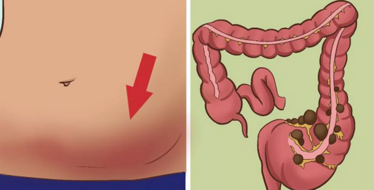 Inilah yang terjadi dalam tubuh manusia, dengan usus dengan sembelit