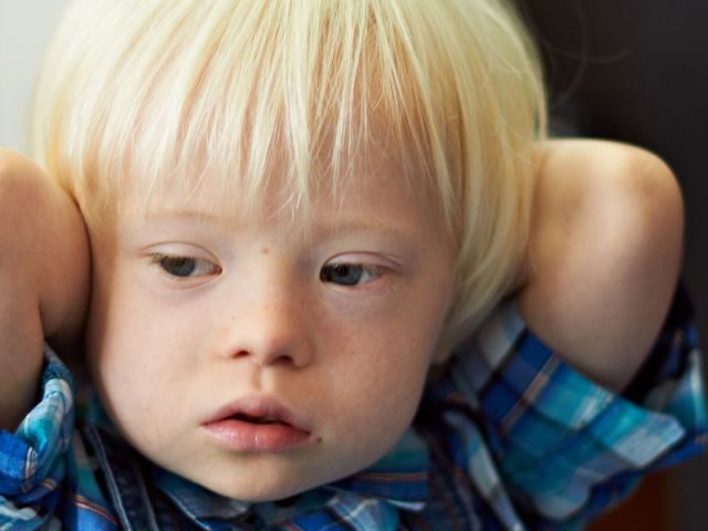 Qu'est-ce que le syndrome de Down? Syndrome de Down: symptômes, causes, traitement de la maladie, signes pendant la grossesse, symbole du syndrome