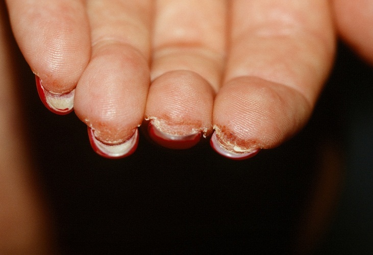 Az allergia újabb megnyilvánulása az ujjakon