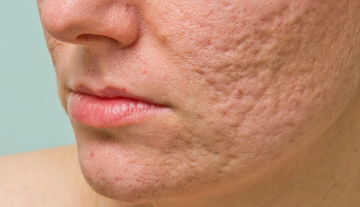 Espinhas depois da acne no rosto
